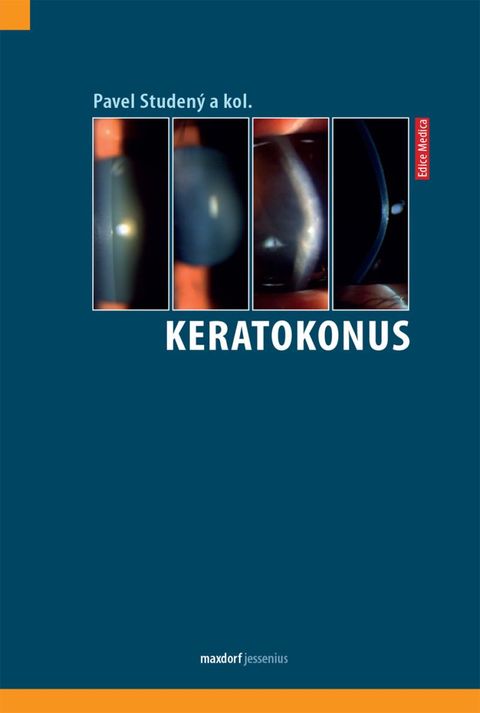 Obrázek produktu: Keratokonus