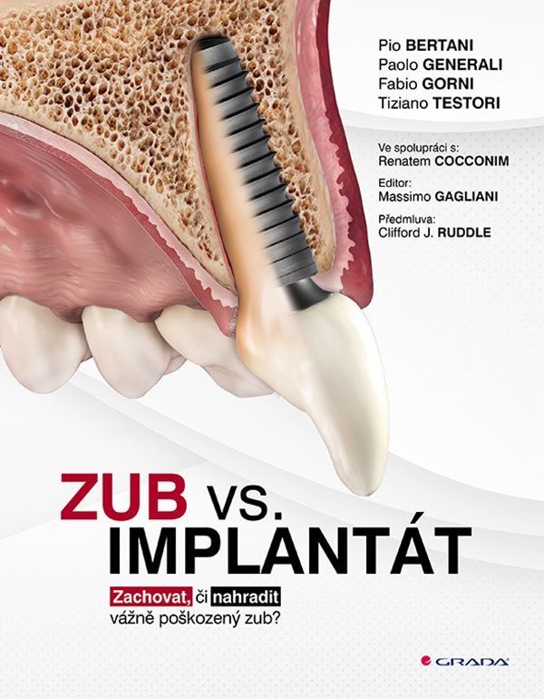 Zub vs. implantát - Zachovat, či nahradit vážně poškozený zub?