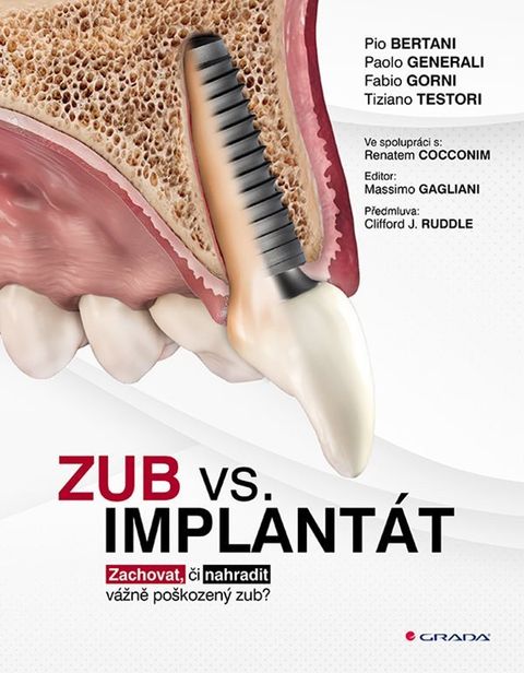 Obrázek produktu: Zub vs. implantát - Zachovat, či nahradit vážně poškozený zub?